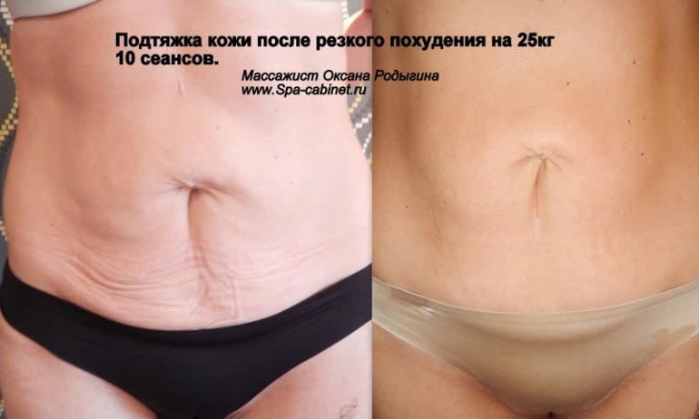 Как похудеть и подтянуть кожу Как похудеть и подтянуть кожу
