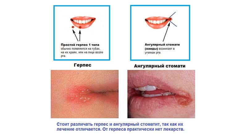 От чего бывают заеды в уголках рта и как лечить От чего бывают заеды в уголках рта и как лечить