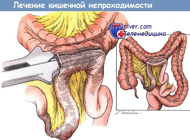 Непроходимость в кишечнике лечение в домашних условиях