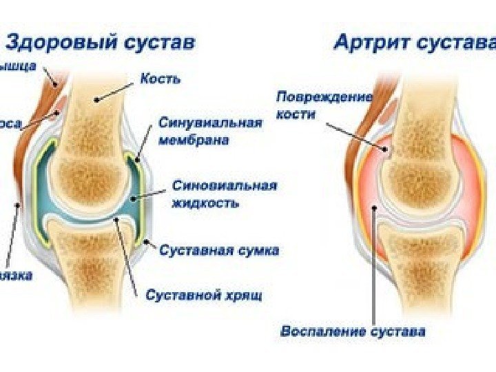 Как лечить воспаление коленного сустава артрит Как лечить воспаление коленного сустава артрит