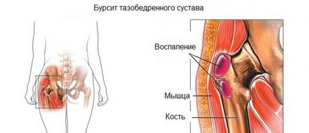 Почему болят тазобедренные суставы у беременных Почему болят тазобедренные суставы у беременных