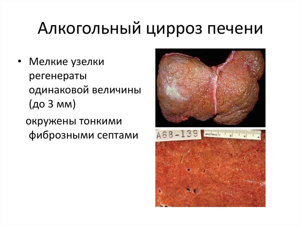 Цирроз печени цветов Цирроз печени цветов