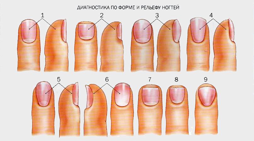 Какие бывают заболеванием ногтей с