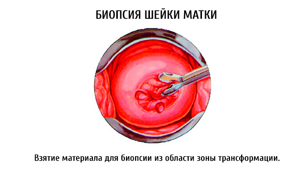 Как лечить рак шейки матки народными средствами Как лечить рак шейки матки народными средствами