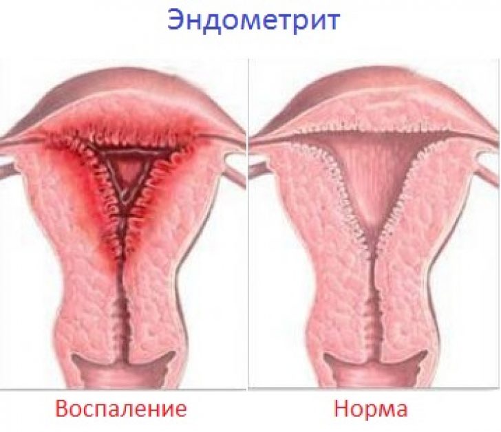 Гинекология женские болезни полипы