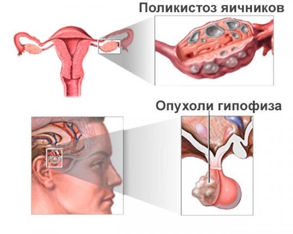 Синдром поликистозных яичников гинекология