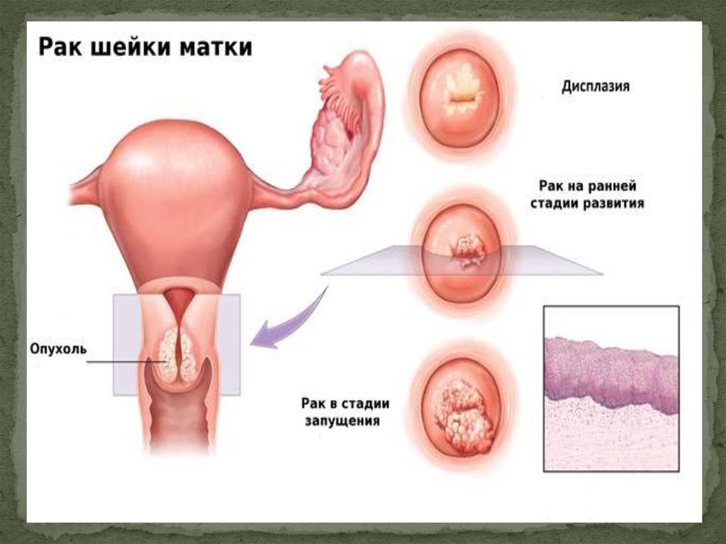 Вирус папилломы человека у женщин гинекология