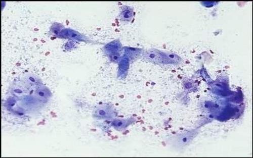 Повышены лейкоциты в мазке у женщины по гинекологии лечение