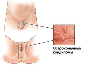 Родинки на коже удаление