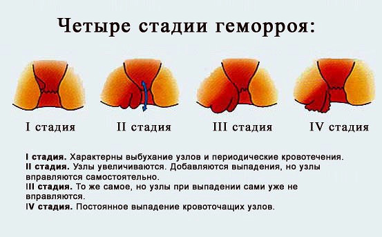 Геморрой от мустурбации Геморрой от мустурбации
